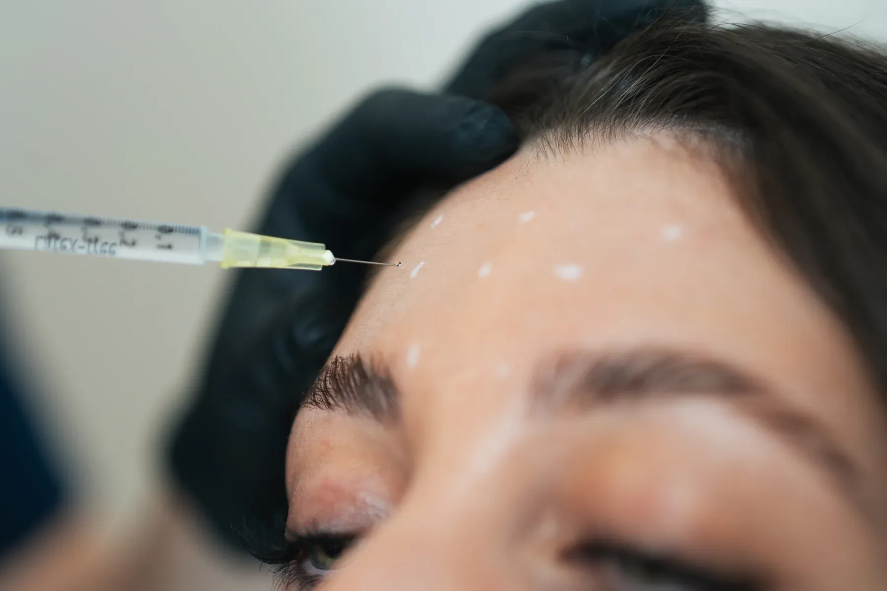 Angezeichnete Injektionspunkte auf der Stirn vor einer Behandlung mit Botulinumtoxin