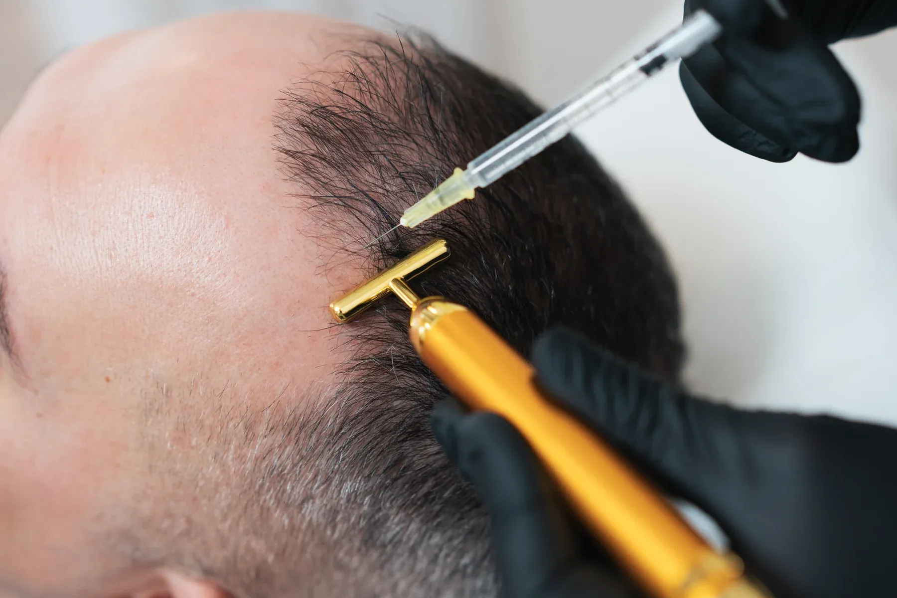 FUE-Haartransplantation in der Praxis am Opernplatz in Frankfurt