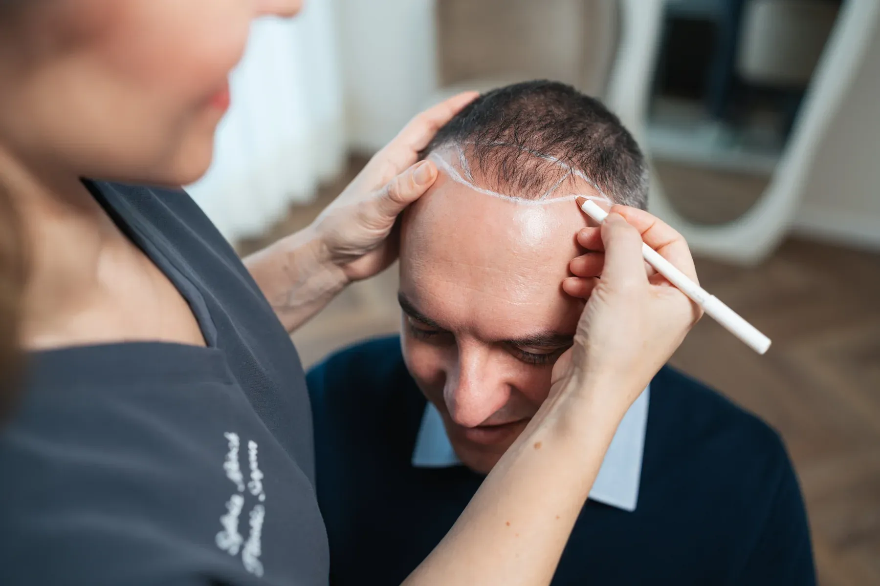 Entwurf der Haarlinie vor einer FUE-Haartransplantation